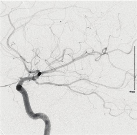 Postoperative Digital Subtraction Angiography Showing Obliteration Of Download Scientific