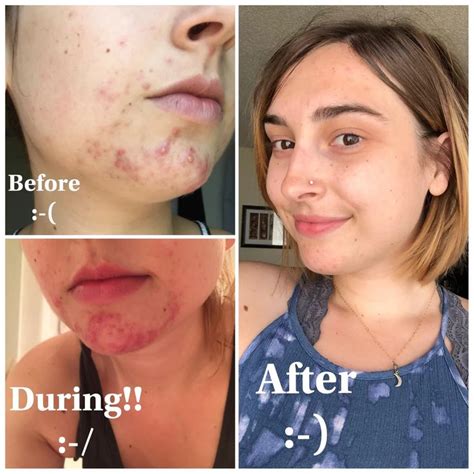 4 before and after using retin a tretinoin 0 025 never ending journey over the course of a