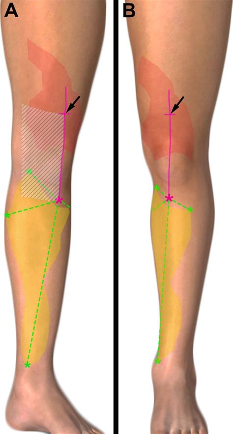 Anesthesia Of The Anterior Femoral Cutaneous Nerves For Total Knee