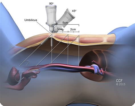 Supraumbilical Primary Trocar Insertion For Laparoscopic Access The