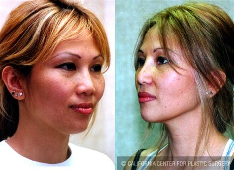 Patient 6379 Asian Rhinoplasty Before And After Photos Beverly Hills