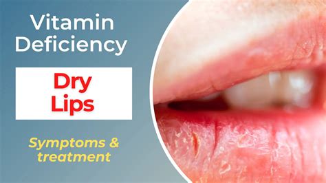 Vitamin Deficiency For Dry Lips Symptoms Causes And Treatments