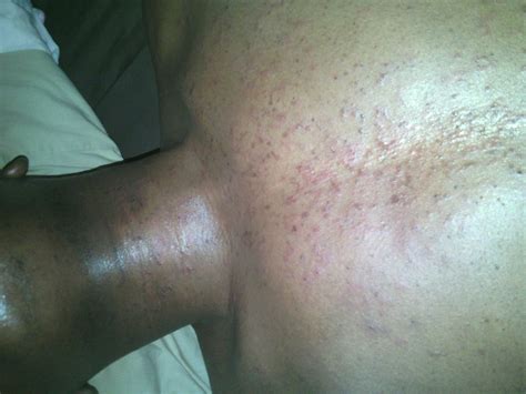 That Rash Pityrosporum Folliculitis Or Keto Rash Or Whatever That Rash