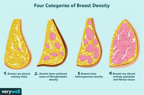 Women With Dense Breasts And Additional Screenings
