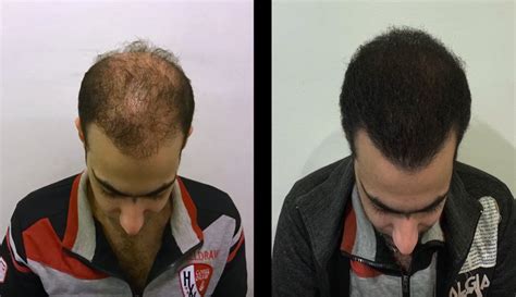 Advantages Of Hair Transplants In Turkey