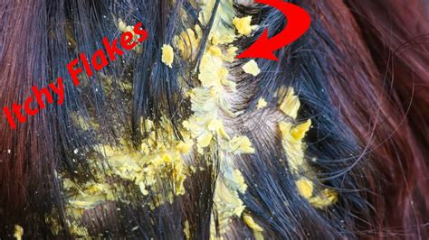 Huge Flakes Close Up Dandruff Scalp Scratching And Picking Itchy Dry