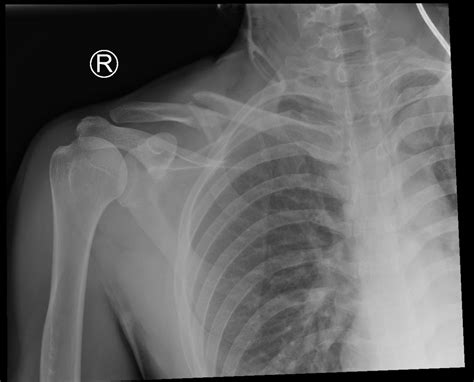 R Clavicular Fracture 1 Day Xray Unannoatated Jetem 2020 Jetem