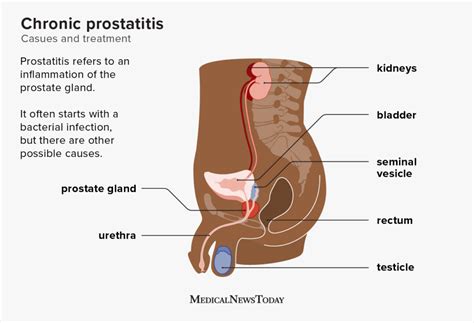 Chronic Prostatitis Causes Symptoms Diagnosis And Treatment