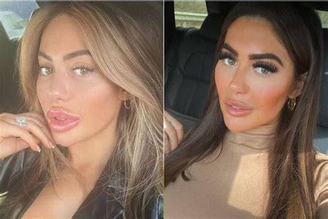 Chloe Ferry Has Lip Fillers Dissolved As Fans Tell Geordie Shore Star She Looks Best She Ever Has