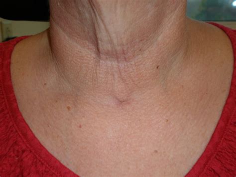 Minimally Invasive Thyroidectomy Atlanta S Advanced Thyroid And