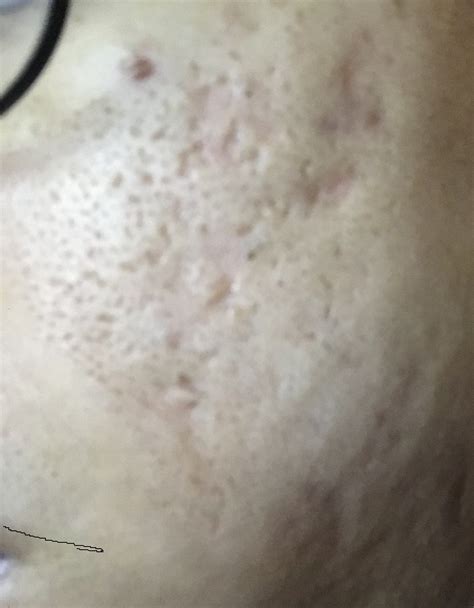 Help With Pitted Scars Hyperpigmentation Reddark Marks