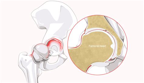 Hip Labrum Tear Causes And Treatment Buxton Osteopathy Clinic