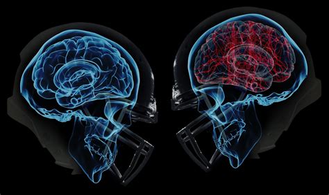 Manual Therapy Treatment For Concussions