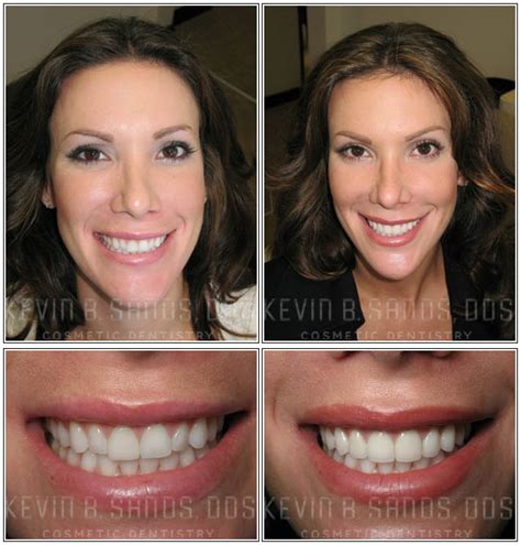 Porcelain Veneers Before And After