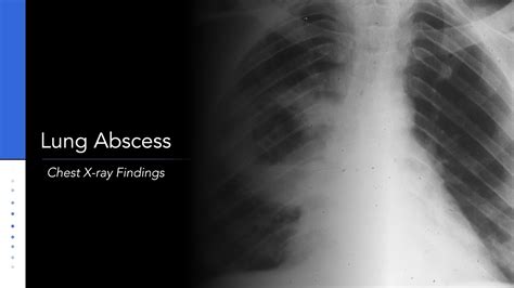 Lung Abscess Explanation Of Chest X Ray Findings Youtube