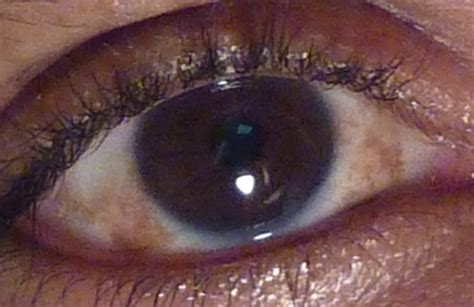 Brown Spot On White Of Eye Avalonitnet