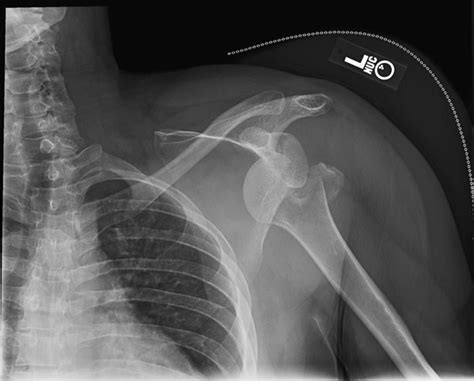 Anteroposterior Radiograph Of The Left Shoulder Showing A Glenohumeral