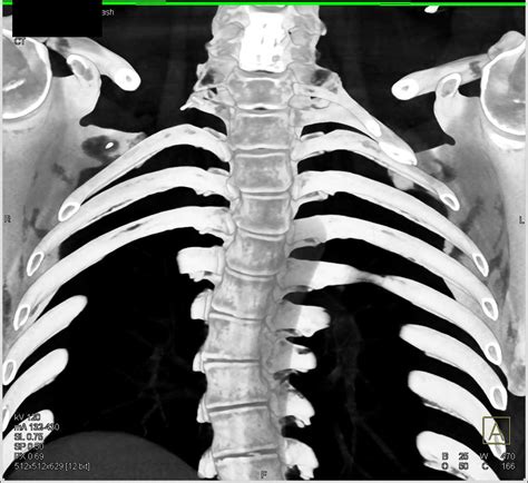 Cervical Ribs With Prior Resection On The Right Side Musculoskeletal