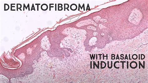 Dermatofibroma With Basaloid Follicular Induction Mimic Of Basal Cell