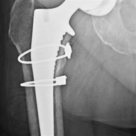 Anteroposterior Radiographs Six Week Post Total Hip Arthroplasty With