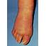 Rash & Swelling On Foot Due To Secondary Syphilis Photograph By Science 