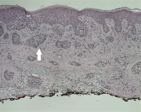 Cureus Metatypical Basal Cell Carcinoma With Intravascular Invasion