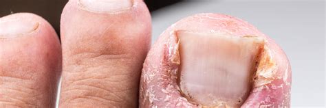 Ingrown Toenails Innovative Foot And Ankle