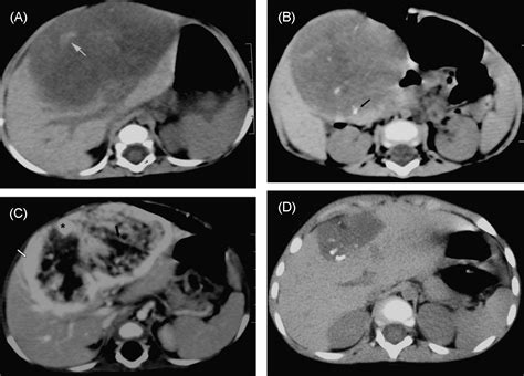 Ct And Mr Imaging Characteristics Of Infantile Hepatic
