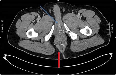 Cureus Occult Perirectal Abscess Causing Acute Urinary Retention