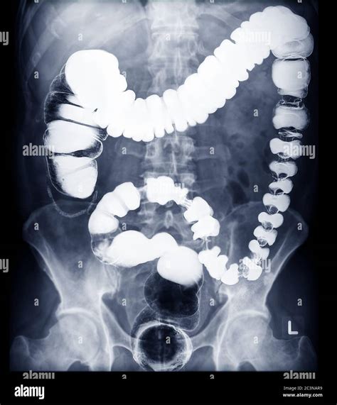 X Ray Intestine Showing Cancer Colon Hi Res Stock Photography And