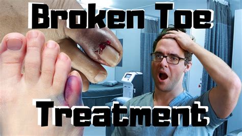 Broken Toe Fracture Treatment Should I See A Doctor Youtube