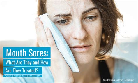 Mouth Sores What Are They And How Are They Treated Simcoe Smile Dental