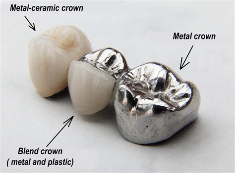 Fabrication Of Crowns And Bridges Ralev Dental Clinic