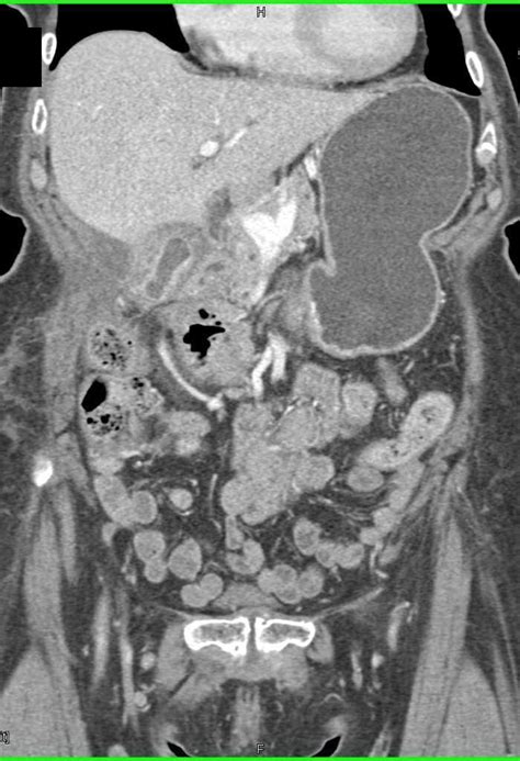 Primary Pancreatic Cancer With Spread Of Disease Pancreas Case