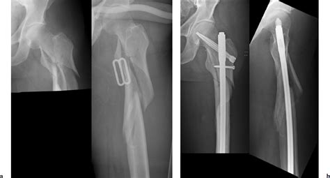 Subtrochanteric Femur Fractures Radiology Key