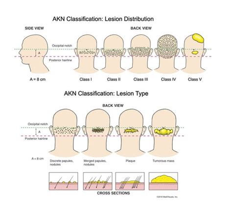 A New Classification System Developed To Improve Treatment For Acne