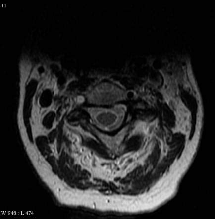 Vertebral Artery Dissection And Thrombosis Image Radiopaedia Org