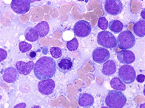 Acute Myeloid Leukemia Without Maturation 2