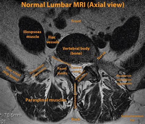 Healthcare Extreme How To Read An MRI Lumbar Spine In 8 Easy Steps