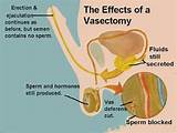 Price Of Vasectomy Pictures