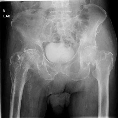 [figure pelvic radiograph right hip fracture contributed by scott dulebohn md] statpearls
