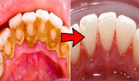 how to remove plaque from teeth without going to the dentist right