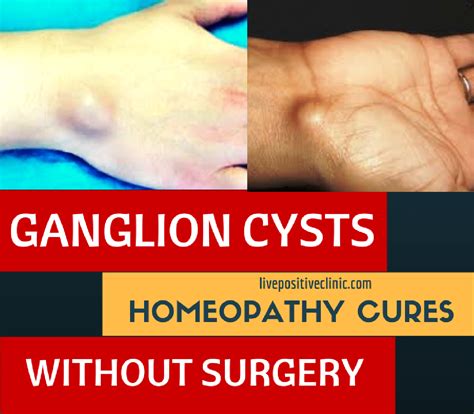 Ganglion Cyst Homeopathy Cures Without Surgery Live Positive