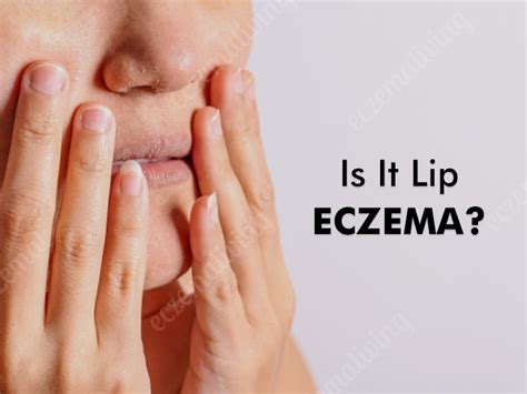 Eczema On Lips Causes Symptoms Treatment And Home Remedies