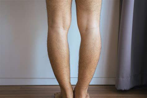 A 28 Year Old Man With Bilateral Bowleg Deformities And Knee Download