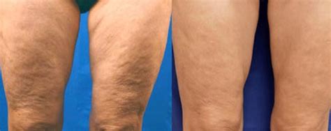 Cellulite Treatments Aesthetic Center Of New Jersey