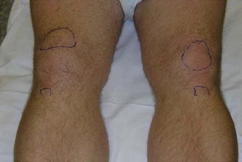 Simultaneous Traumatic Rupture Of The Patellar Tendon And The