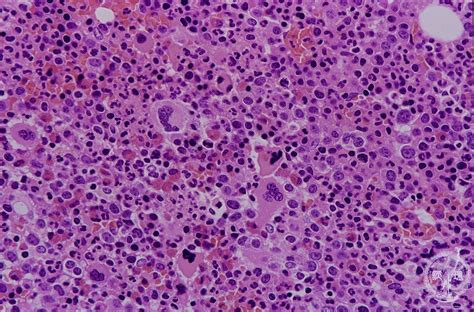 1bone Marrow Hematopoietic System 6 Myeloproliferative Disorders