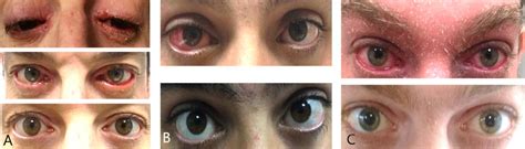 Dupilumab Induced Ocular Surface Disease Diosd In Patients With