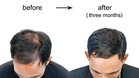 Hair Loss An Increasing Incidence Among Men And Women Treat It